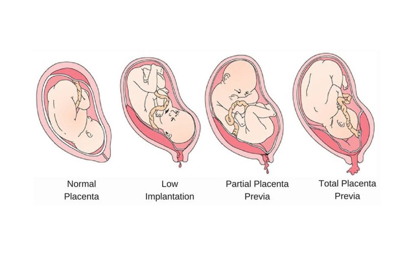 সিজারের পর নেক্সট প্রেগনেন্সিতে নরমাল ডেলিভারি সম্ভব কি?