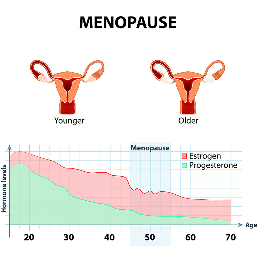 মেনোপজ | রজোবন্ধ বা স্থায়ীভাবে মাসিক বন্ধ হওয়ার উপসর্গগুলো কী?