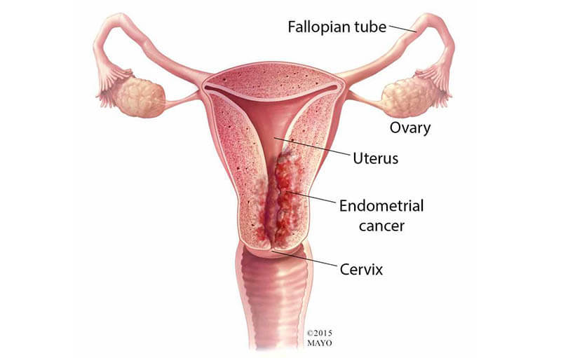 মাসিকে অতিরিক্ত রক্তক্ষরণ | লক্ষণ, কারণ, রোগ নির্ণয় ও চিকিৎসা জানেন তো?