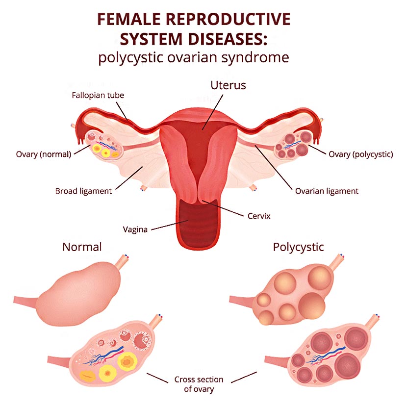 ইনফার্টিলিটি কেস স্টাডি | জেনে নিন বন্ধ্যাত্বের ৩টি বাস্তব ঘটনা!