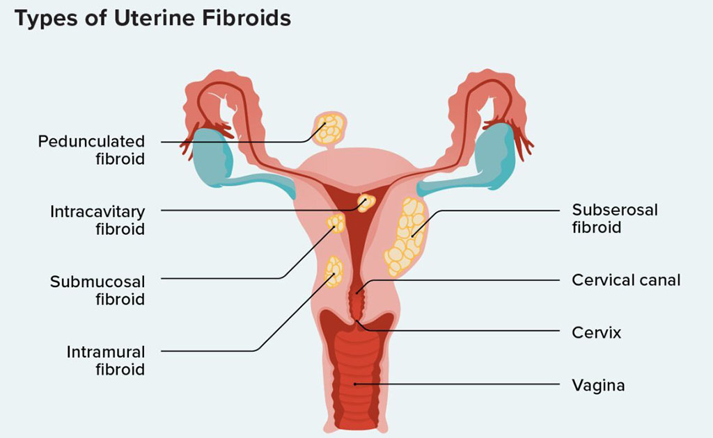 জরায়ুর ফাইব্রয়েড টিউমার কি প্রেগনেন্সির জটিলতা বাড়িয়ে দিতে পারে?