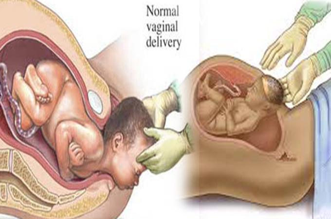 সি সেকশন | জরুরী মেডিকেল কন্ডিশন নাকি ঐচ্ছিক সিদ্ধান্ত!