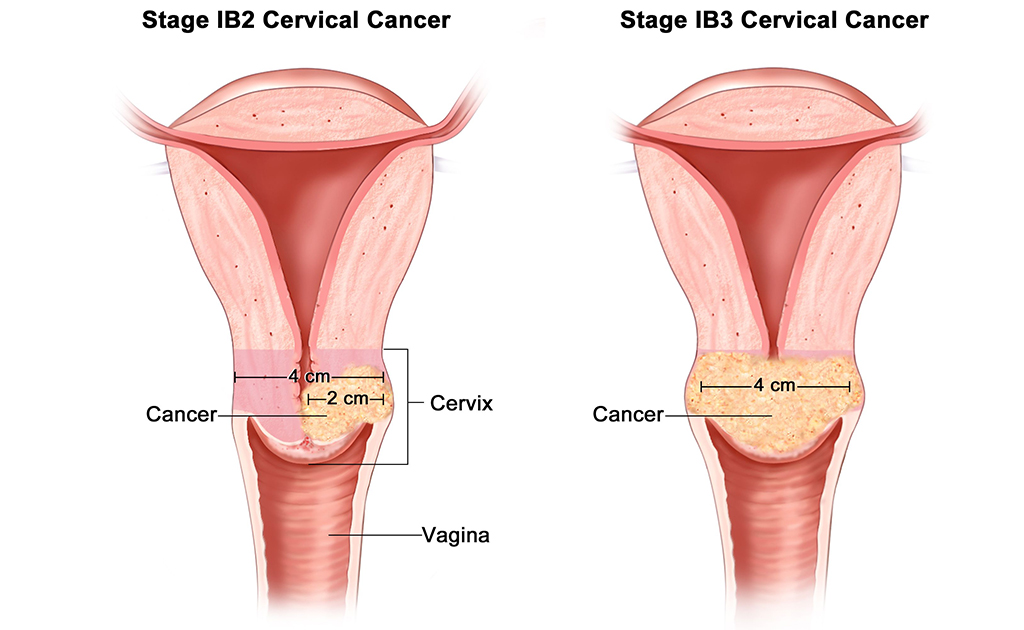 সার্ভিক্যাল বা জরায়ুমুখের ক্যান্সার নিয়ে আপনি সচেতন তো?